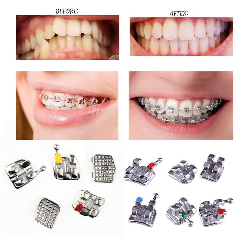 VEZE حاملات الأسنان، حاملات لتقويم الأسنان، 5 مجموعات 100 قطعة نموذج أسنان تقويم الأسنان حاملات MBT مصغرة MBT 022 فتحة قابلة للربط، 345 خطاف. - Image 4